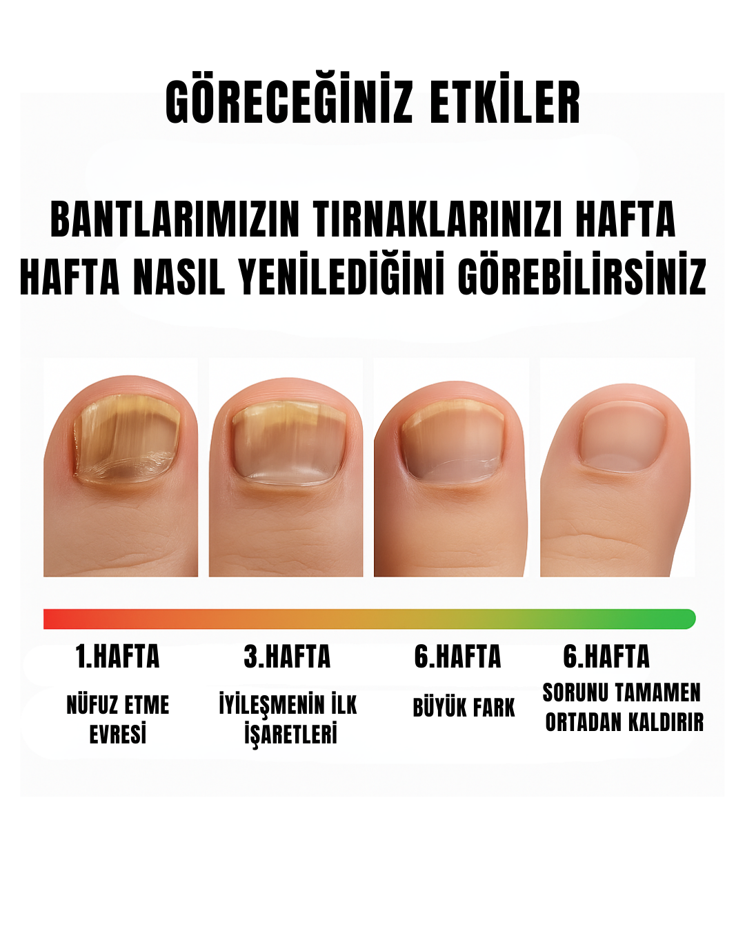 BANDİVA TIRNAK MANTARI BANTLARI